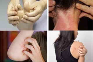 how to stay away from Skin Infection