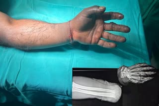 reattached hand