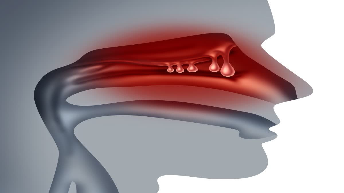 Nasal Polyps Treatment