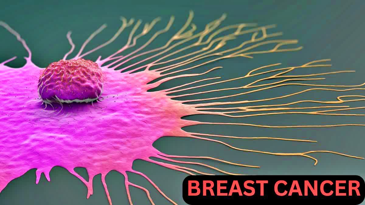 BREAST CANCER