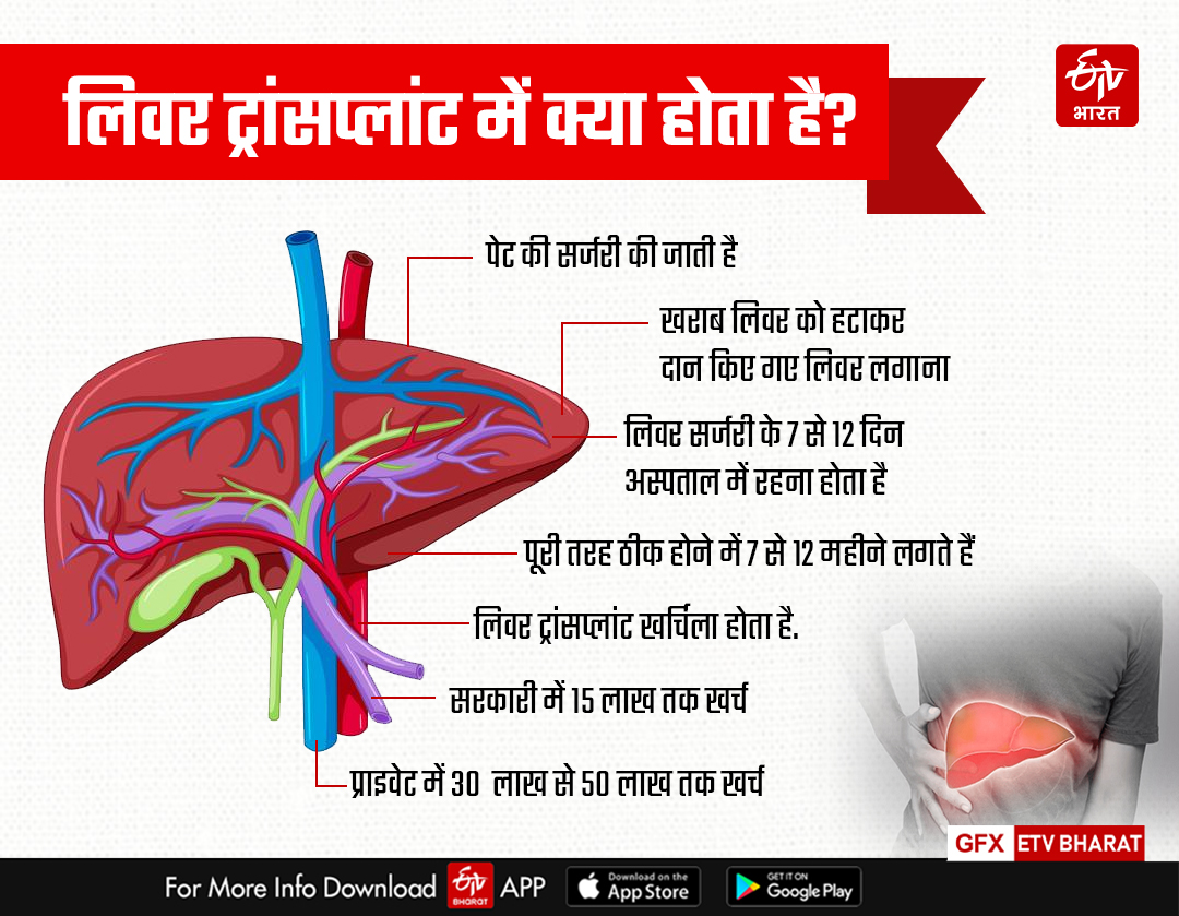 लिवर ट्रांसप्लांट क्या है?