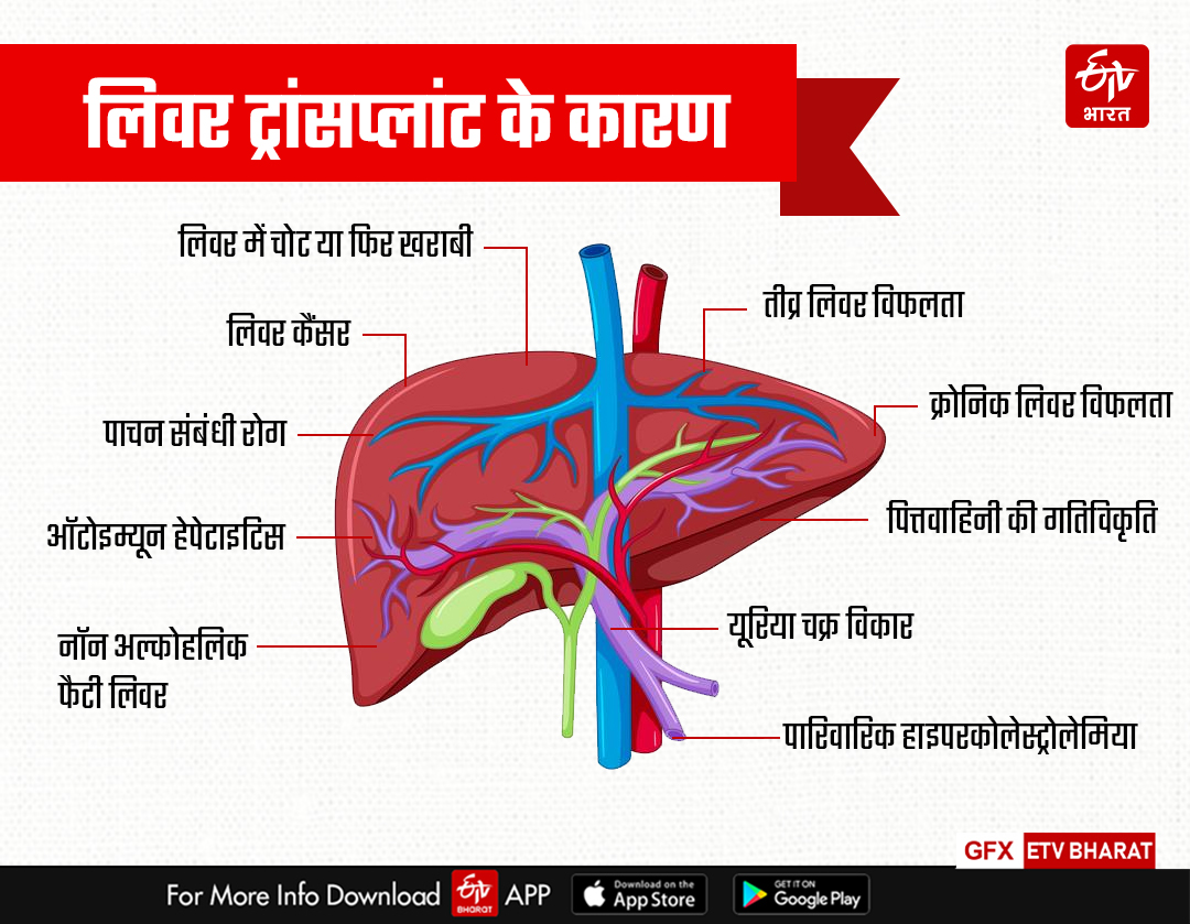 लिवर ट्रांसप्लांट के कारण