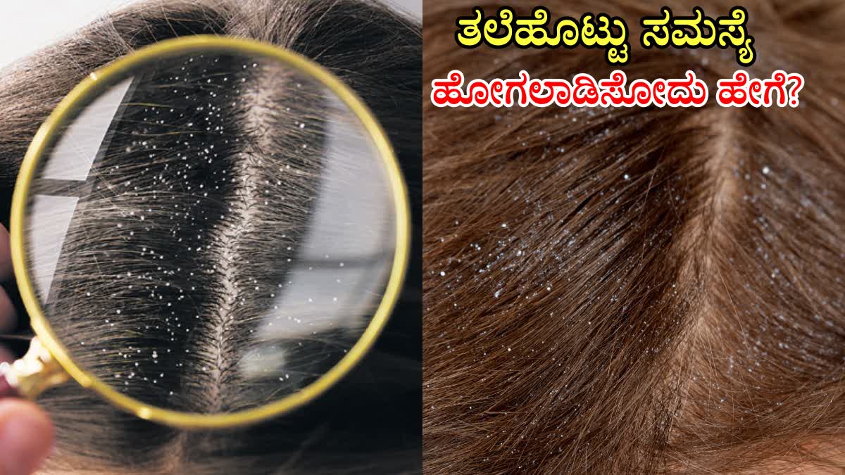 HOW TO TREAT DANDRUFF IN WINTER  HOW TO MANAGE DANDRUFF IN WINTER  HOW TO HANDLE DANDRUFF NATURALLY  DANDRUFF HOME REMEDIES