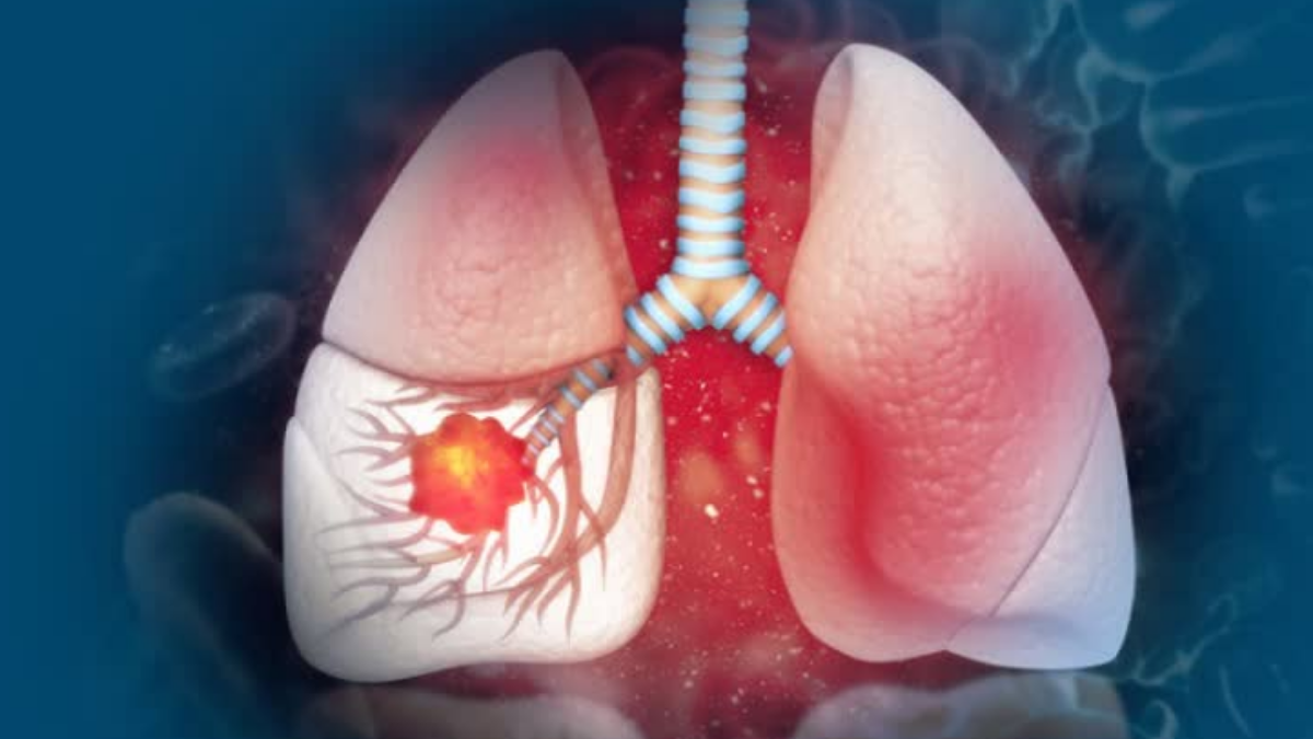 Is a cough that lasts more than three weeks a sign of lung cancer?