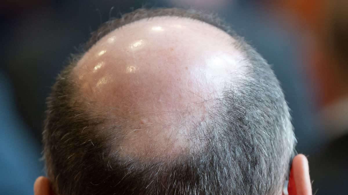 Tips for baldness