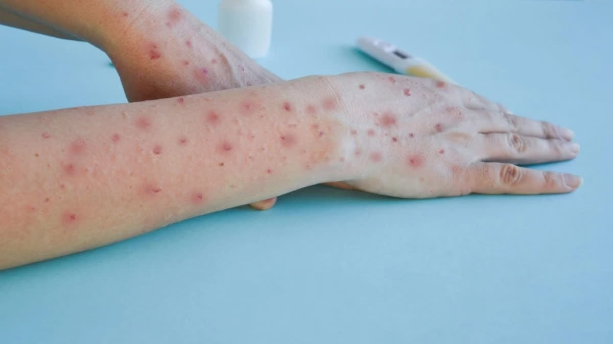 Pakistan Detects First Mpox Case Of 2025 At Peshawar Airport