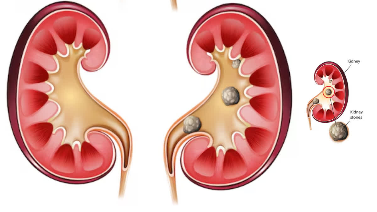 If you also have these symptoms then understand that you have kidney stone, do not eat these 4 foods even by mistake