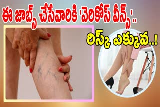 VARICOSE VEINS CAUSES