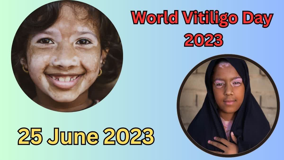 World Vitiligo Day 2023