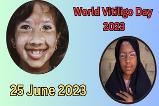 World Vitiligo Day 2023