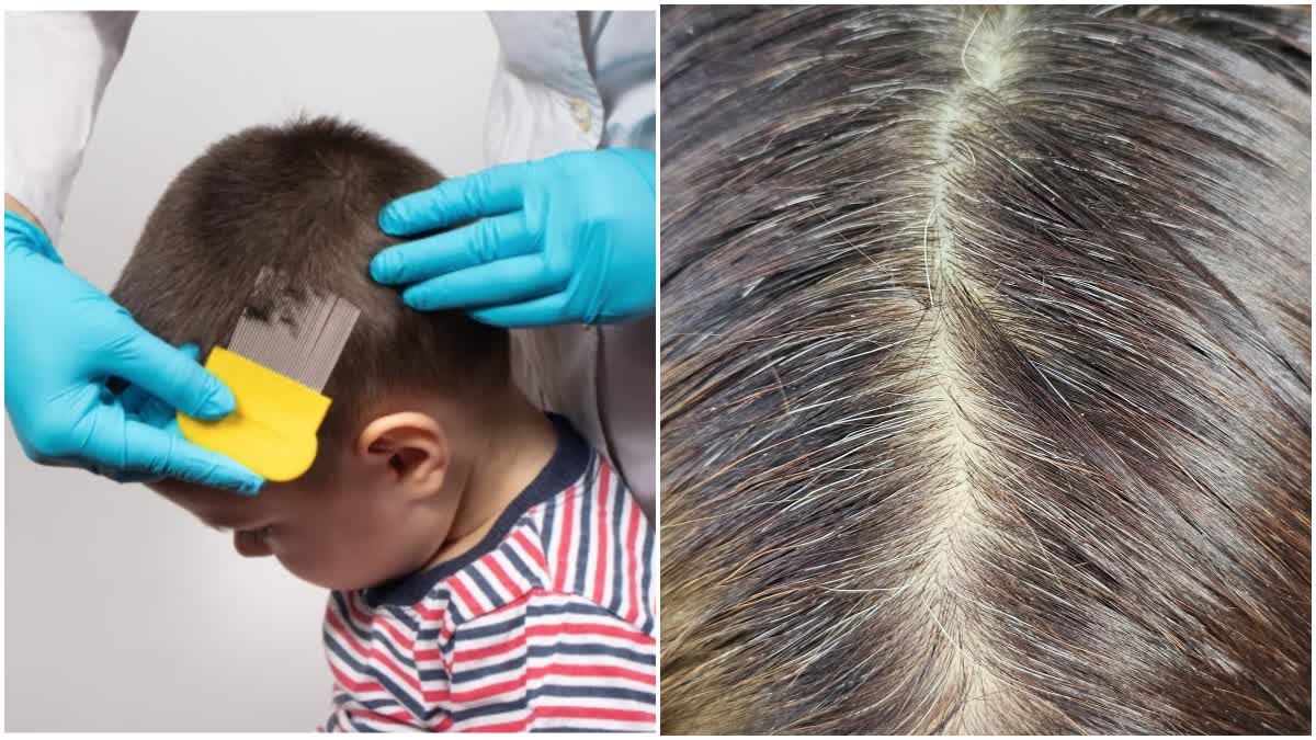 White Hair Problem in Children