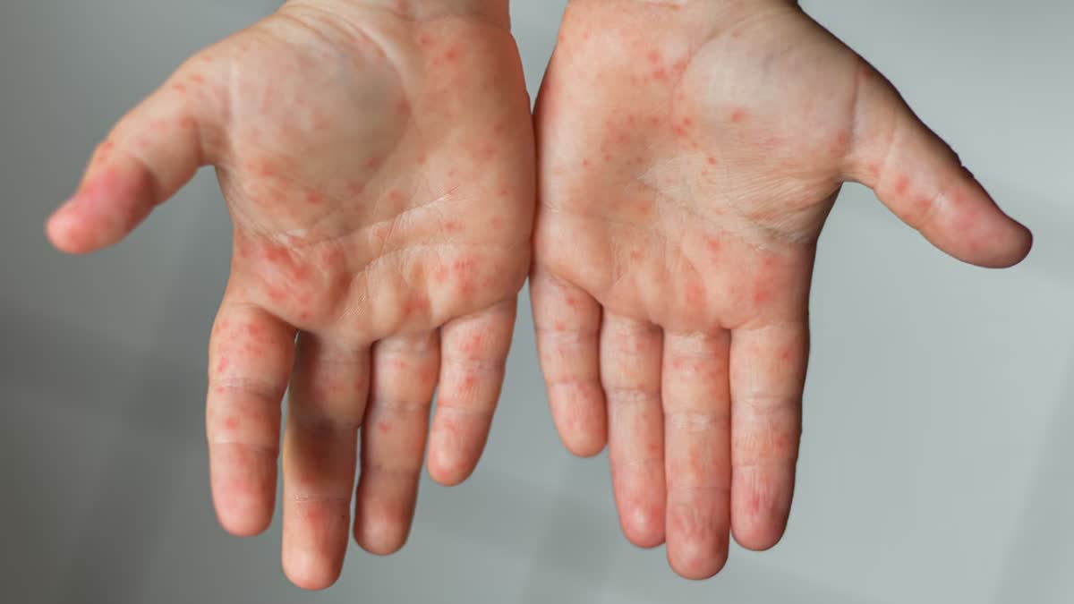 Measles Cases Skyrocket to Highest Level in Over 25 Years
