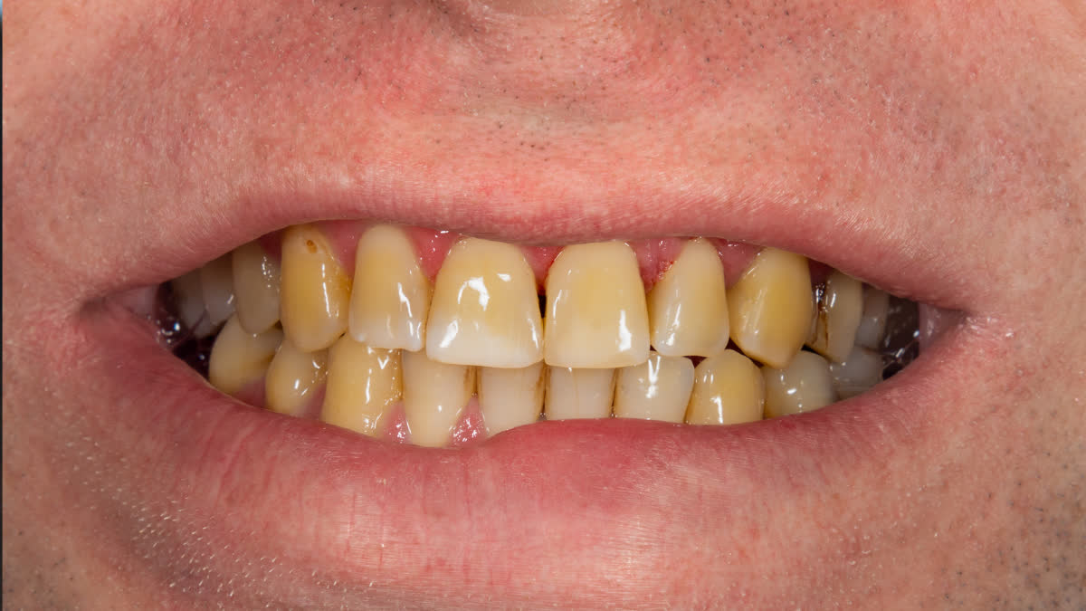 These 5 habits are the reason for your yellow teeth! Stop them today and your teeth will start shining in 2 days
