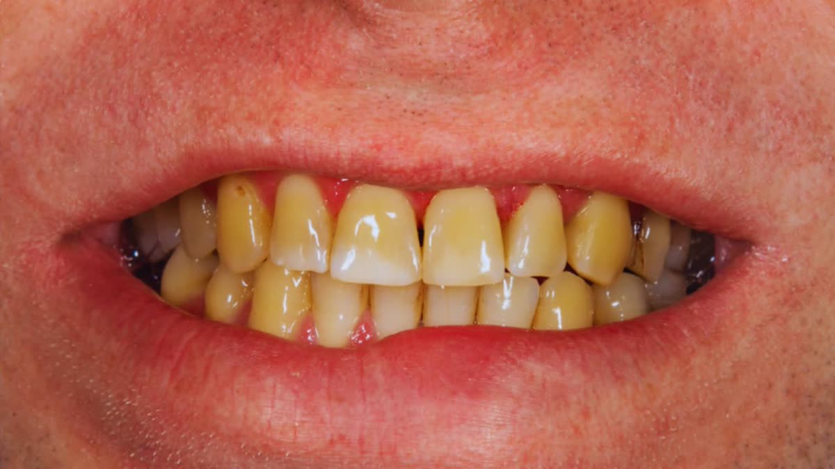 CAUSES OF YELLOW TEETH
