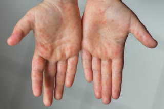 Measles Cases Skyrocket to Highest Level in Over 25 Years