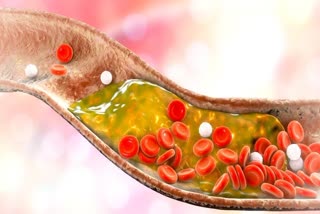 WORST FOODS FOR HIGH CHOLESTEROL  FOODS THAT RAISE CHOLESTEROL LEVEL  FOODS THAT INCREASE BAD CHOLESTEROL  CHOLESTEROL