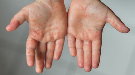 Measles Cases Skyrocket to Highest Level in Over 25 Years