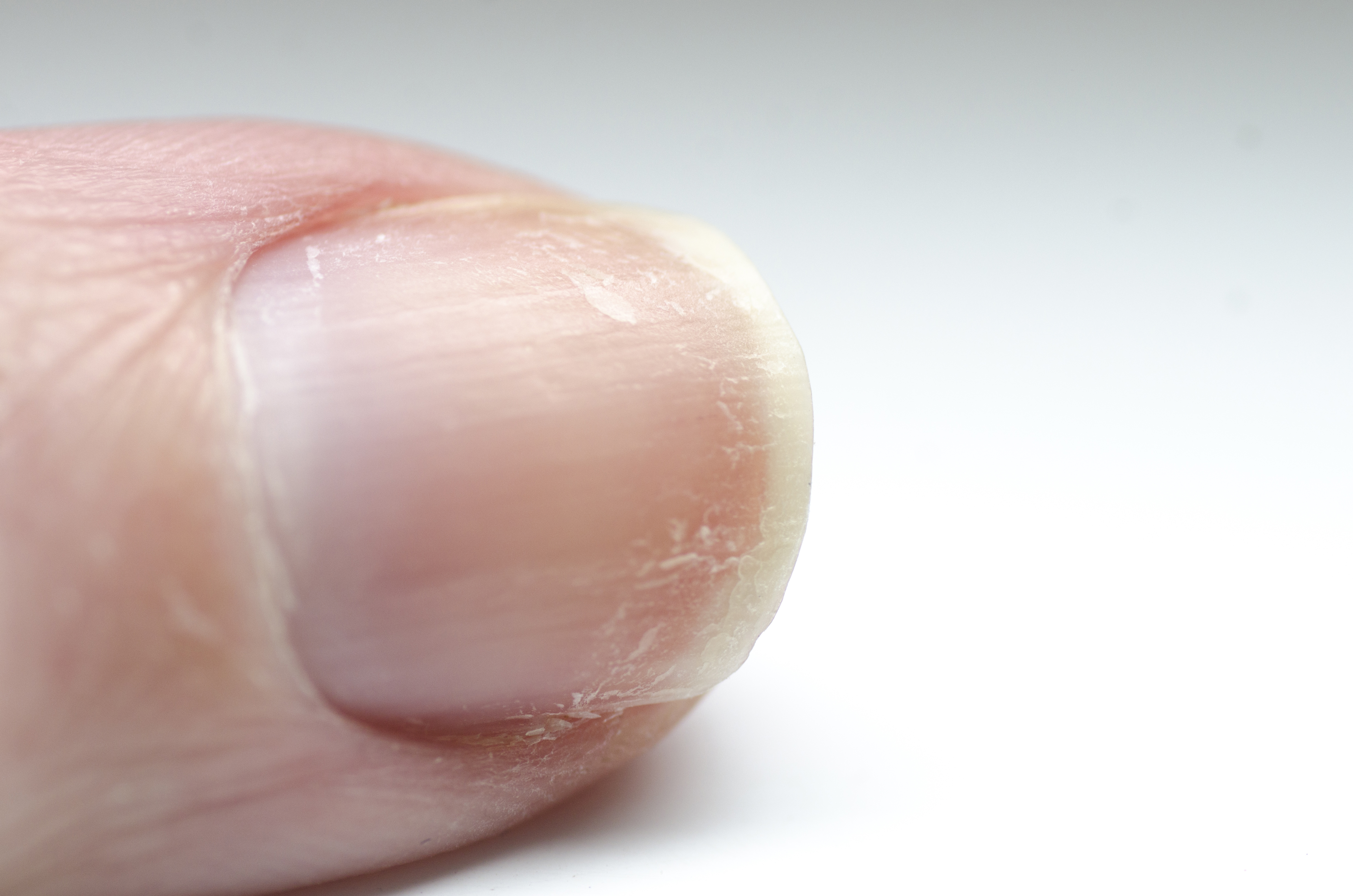 Etv BharatWhy do white spots appear on nails? Which disease is this a symptom of? Know here