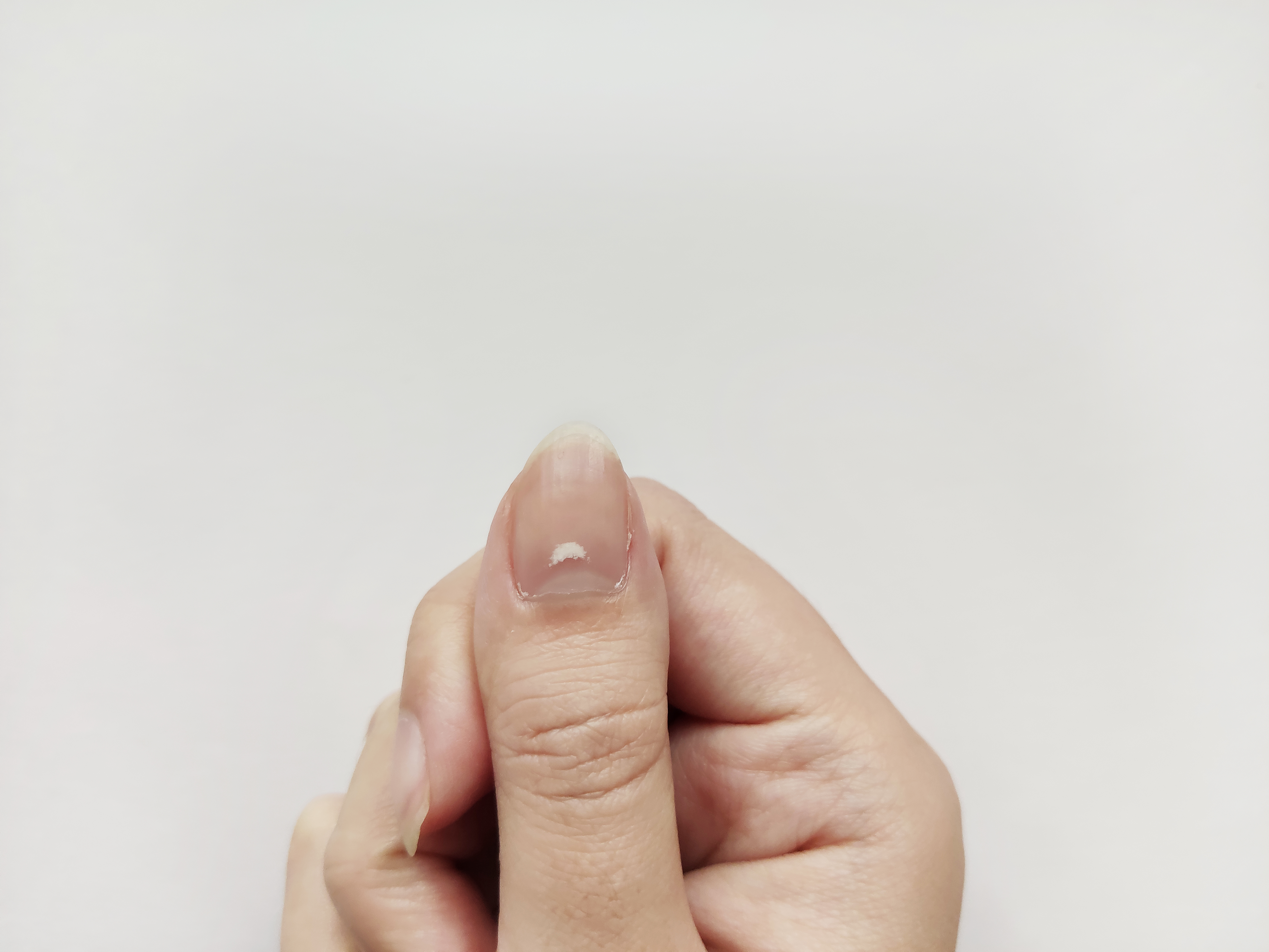 Etv BharatWhy do white spots appear on nails? Which disease is this a symptom of? Know here