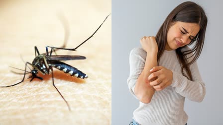 Mosquito Bites Home Remedies