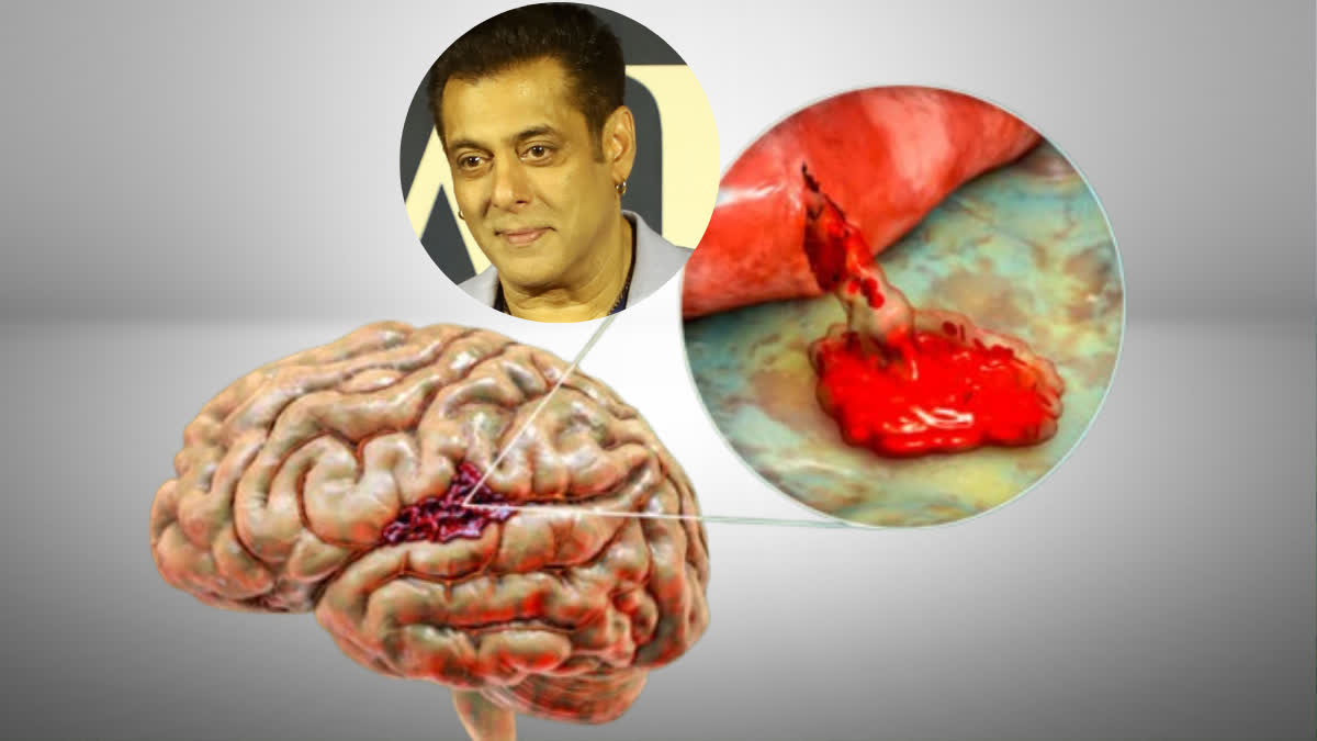 सलमान खान को है ब्रेन एन्यूरिज्म की बीमारी, जानें इसमें क्यों फट जाती हैं  दिमाग की नसें, क्यों रहता है हेमरेजिक स्ट्रोक का खतरा
