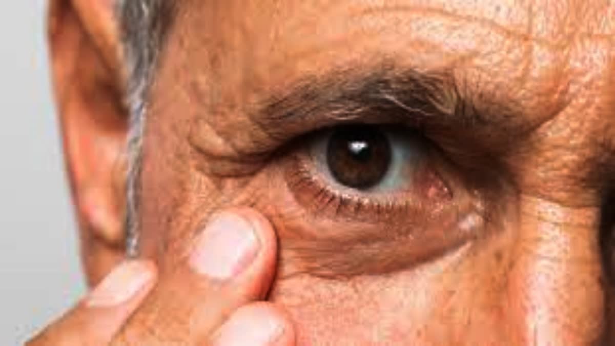 Ahmedabad Conjunctivitis: અમદાવાદમાં આંખ આવવા’ની બીમારી વકરી, કન્જેક્ટિવાઇટિસ એક સપ્તાહમાં  12 હજાર કેસ