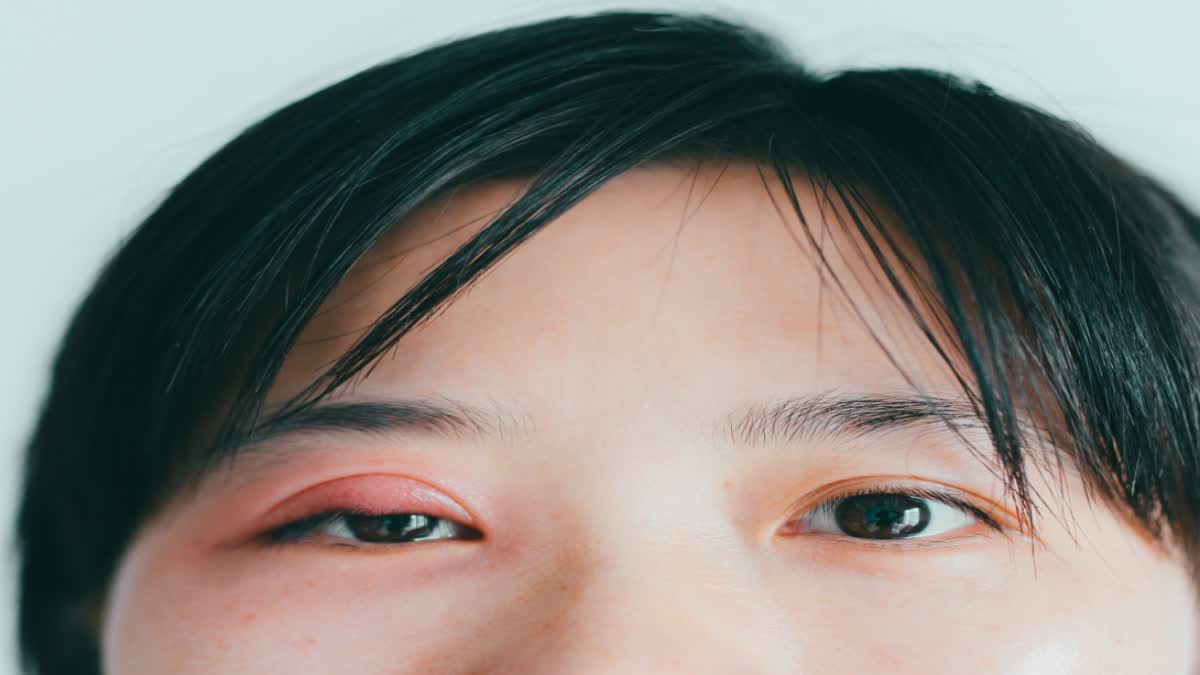 Eyes Swelling Remedies