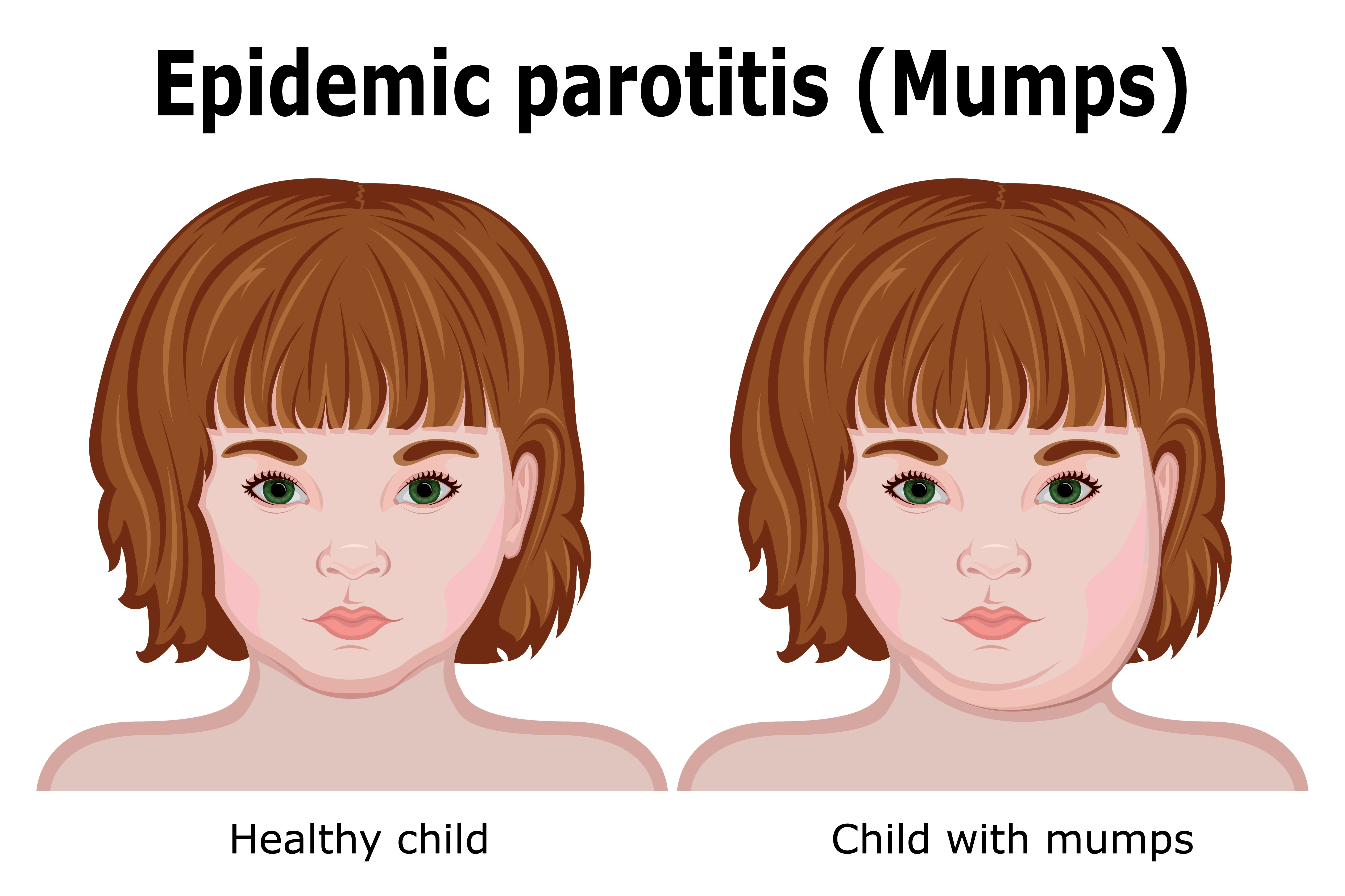 குழந்தைகளுக்கு MMR Vaccine போடப்படுவதை உறுதி செய்ய வேண்டும்