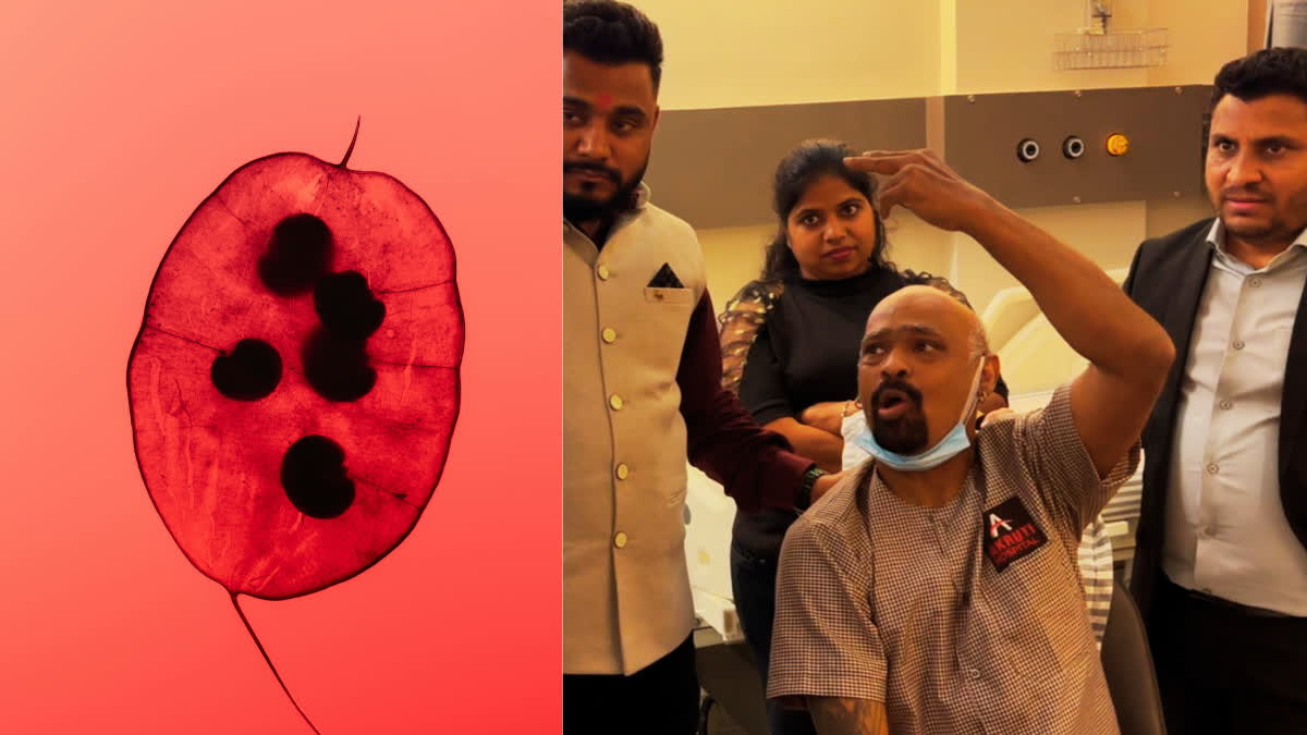 Blood clots are forming in former cricketer Vinod Kambli's brain