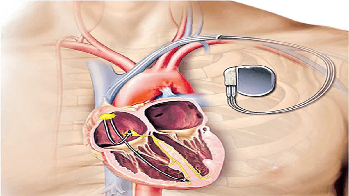 precautions of pacemakers News