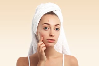 Acne Problem