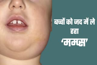 Mumps Disease