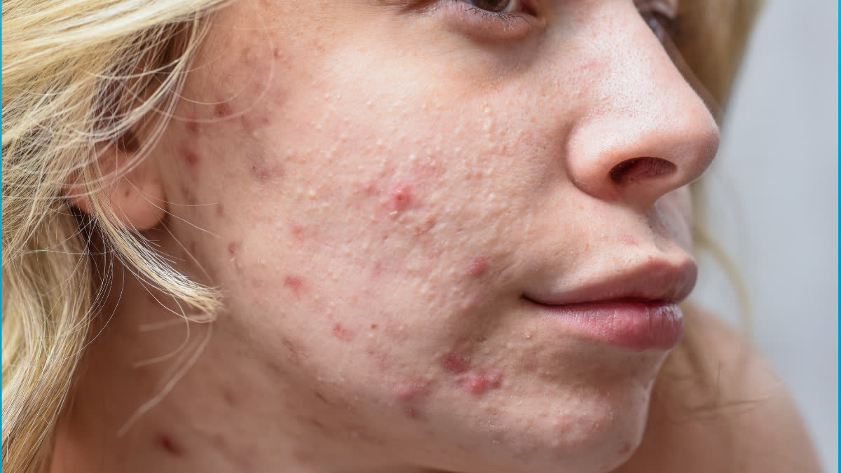 When did acne face mapping start? What can it tell you about your health?