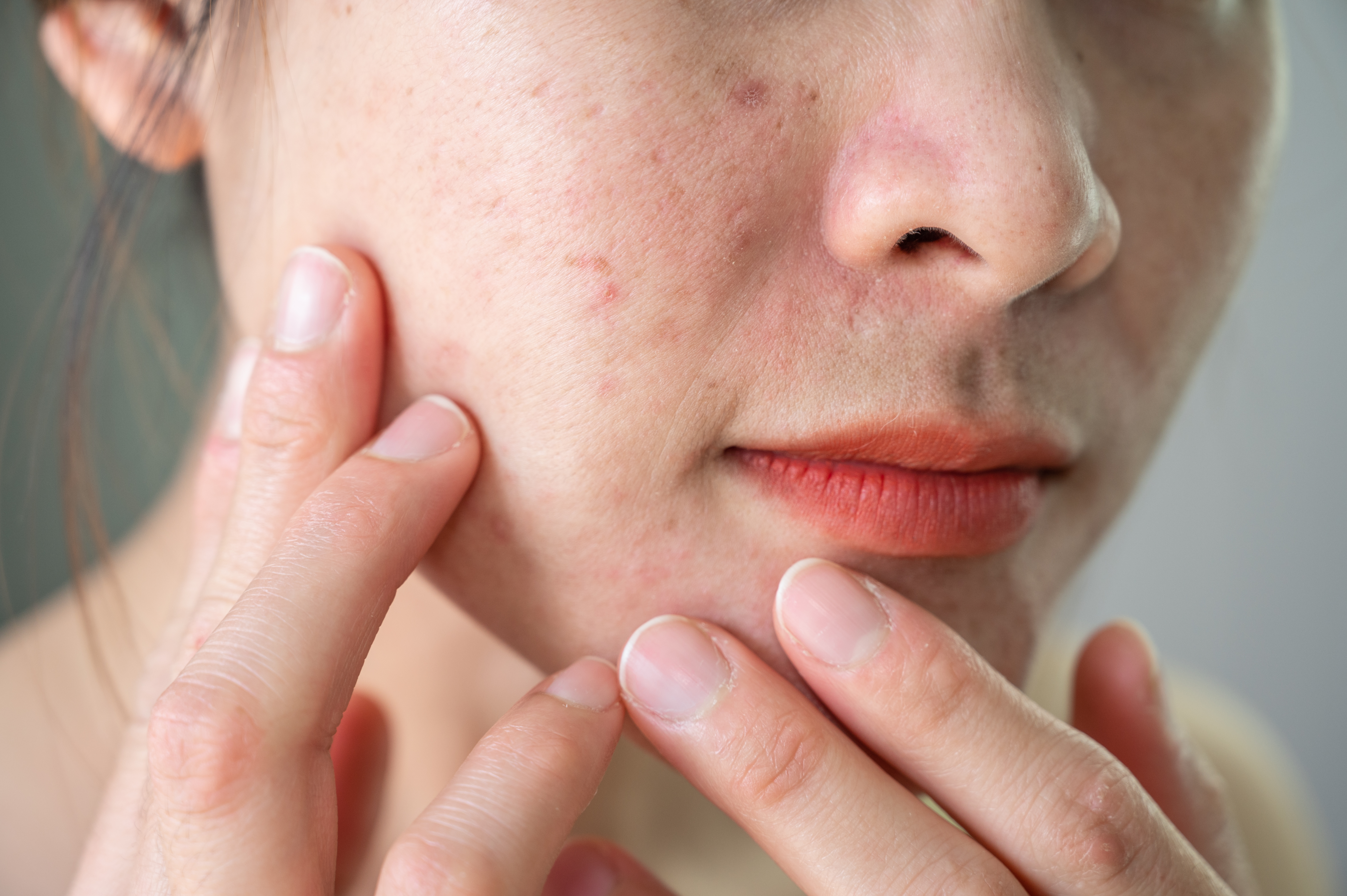 When did acne face mapping start? What can it tell you about your health?