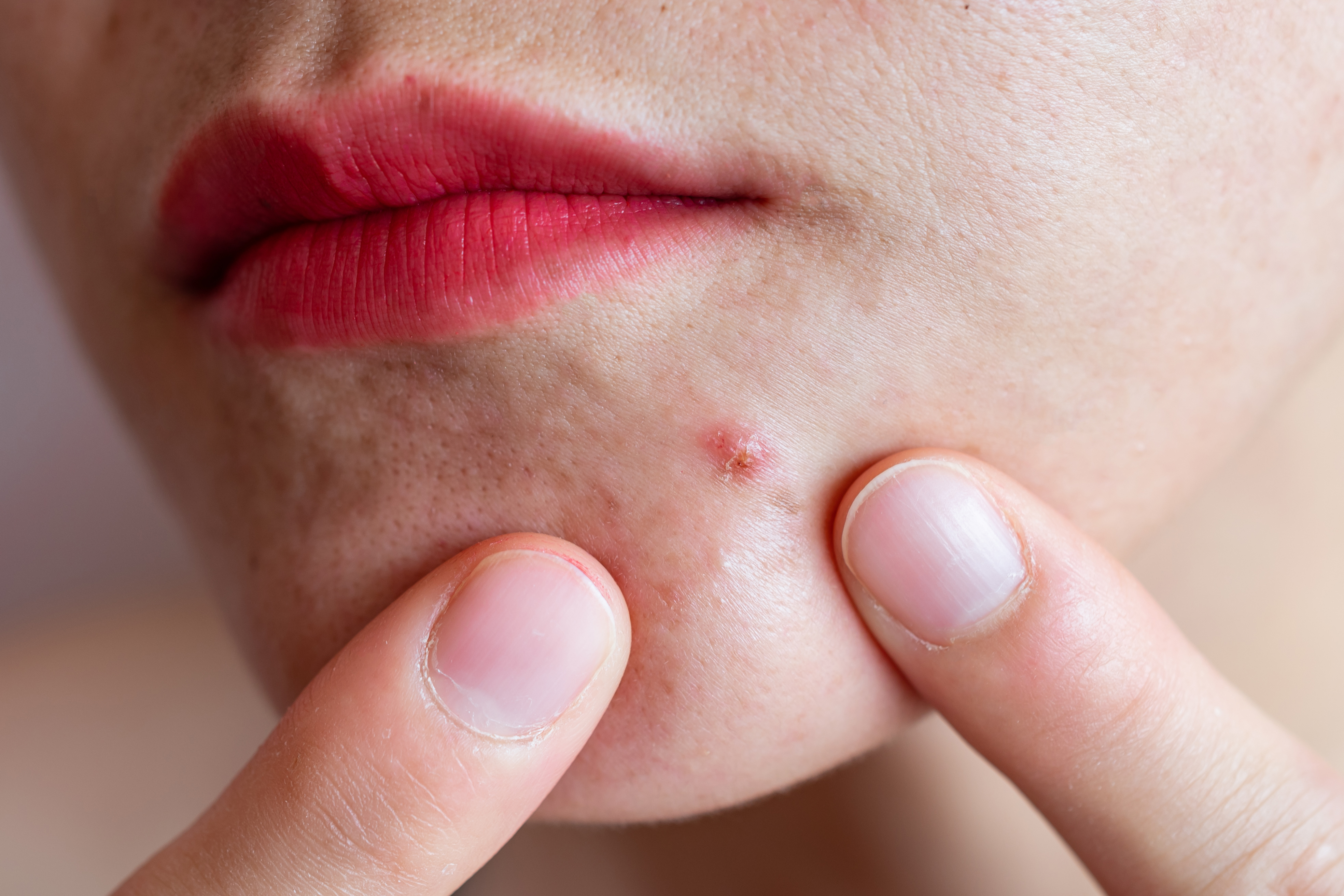 When did acne face mapping start? What can it tell you about your health?
