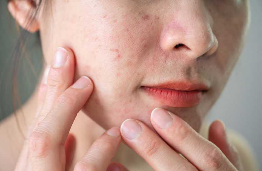 How to get rid of acne
