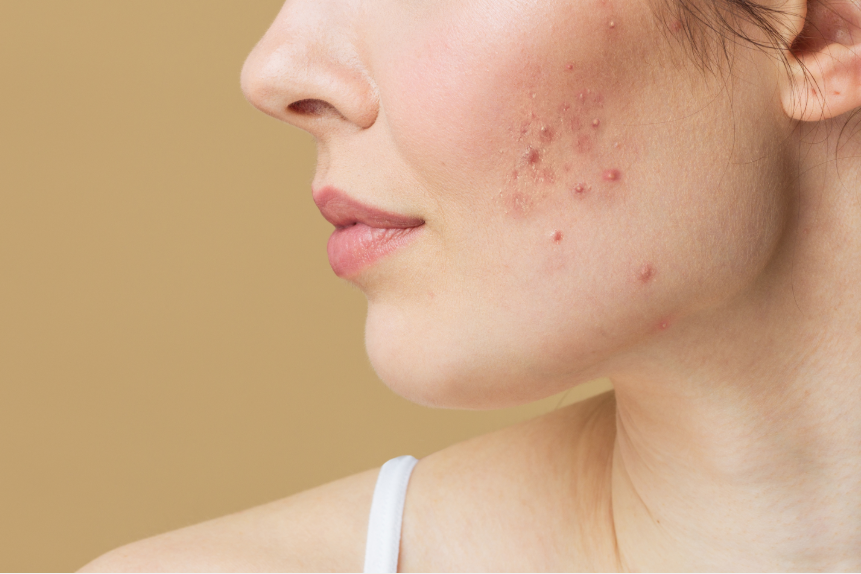 How to get rid of acne