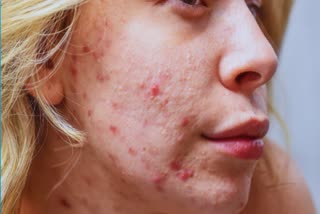 How to get rid of acne