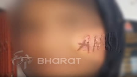 UP: Minor Girl Refuses Marriage, Jilted Lover Writes His Name on Her Face With Hot Iron