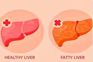 non alcoholic Fatty Liver