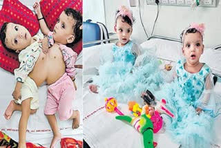 Conjoined Twins Separated Successfully