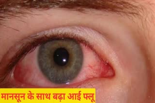 Conjunctivitis EYE FLU