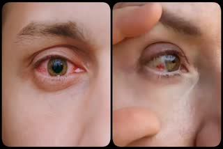 Conjunctivitis Eye Flu