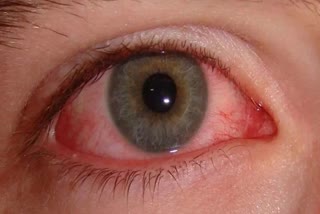 Eye Flu - Conjunctivitis - pink eye