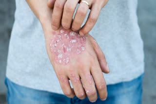 psoriasis treatment causes prevention medicines how to cure psoriasis permanently