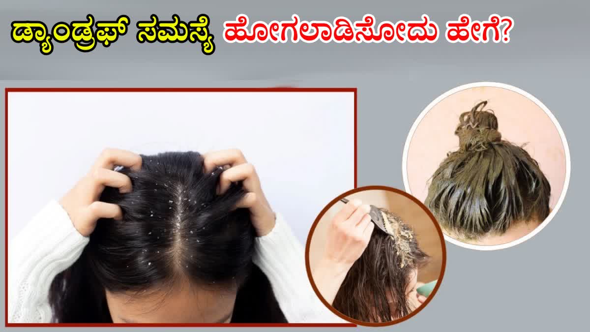 HAIR PACKS FOR DANDRUFF  HOW TO REDUCE DANDRUFF  HOW TO TREAT DANDRUFF PROBLEM  DANDRUFF REDUCING HAIR PACKS