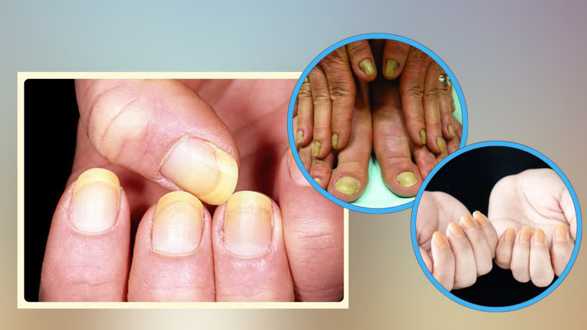 Yellow Nail Syndrome Symptoms