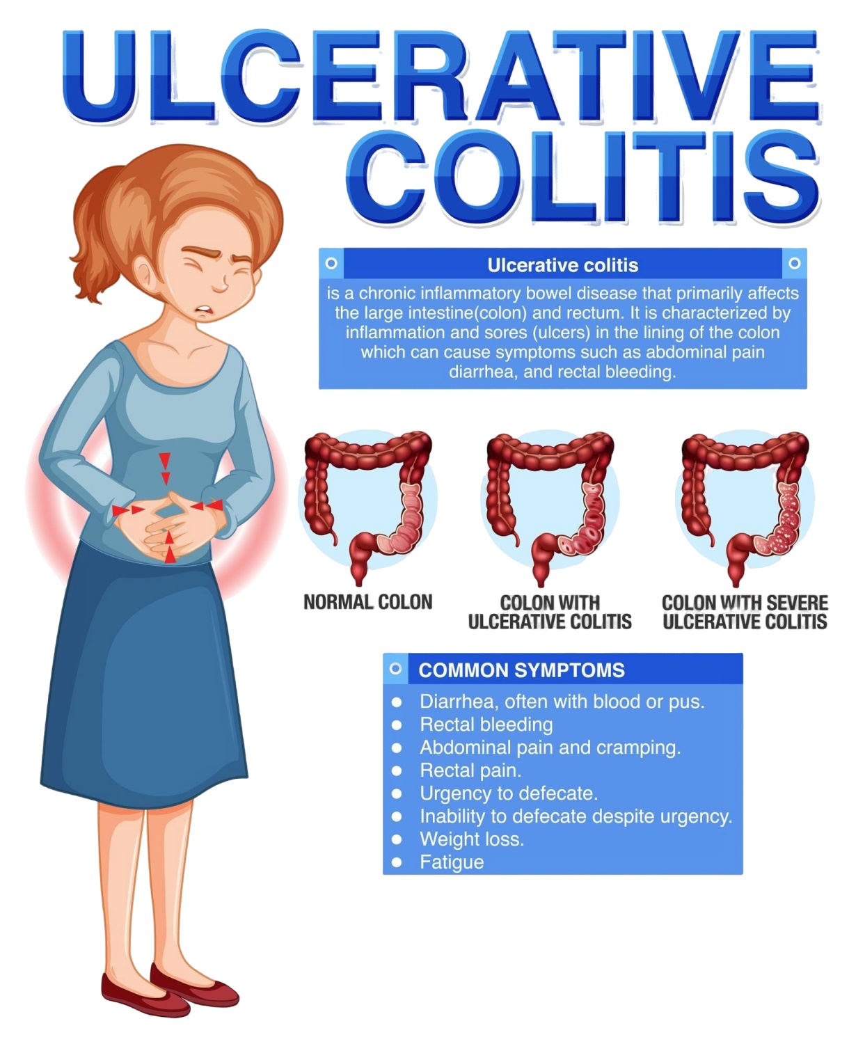 Ulcerative colitis