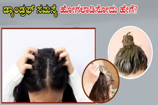 HAIR PACKS FOR DANDRUFF  HOW TO REDUCE DANDRUFF  HOW TO TREAT DANDRUFF PROBLEM  DANDRUFF REDUCING HAIR PACKS