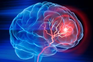 BLOOD CLOT IN BRAIN SYMPTOMS